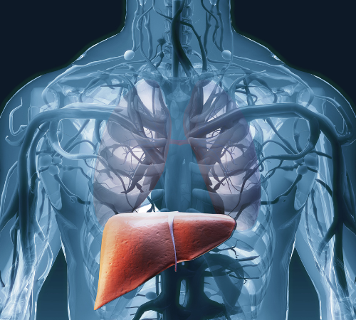 Cirrhosis