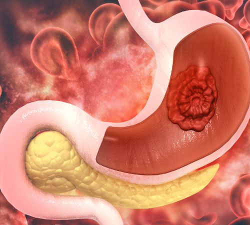 Infectious Colitis