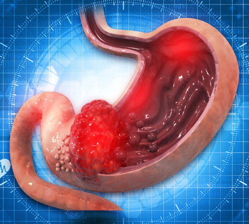Gastroparesis