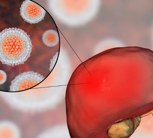 Hepatitis