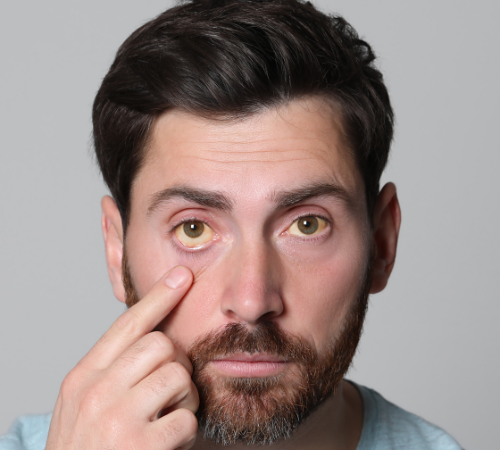 Jaundice