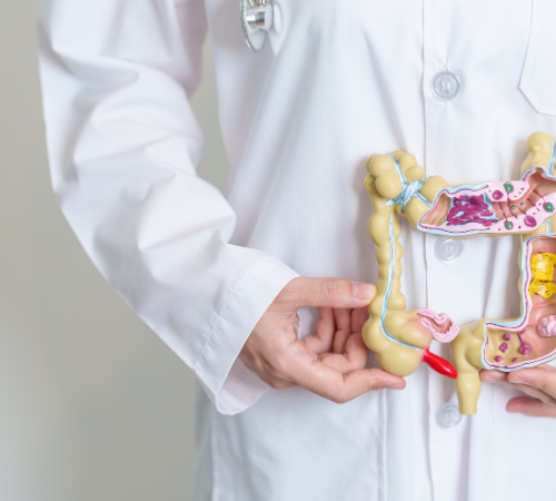 Diverticulosis