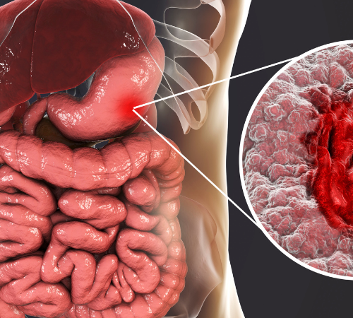 Gastric Ulcer